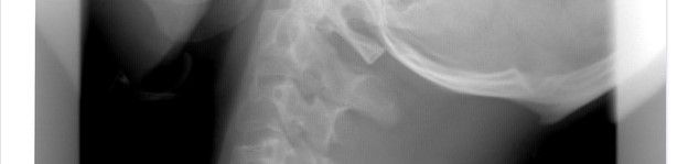 ¿Qué es la lordosis cervical?