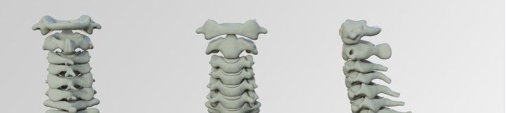 Consecuencias de una rectificación cervical en accidente de circulación